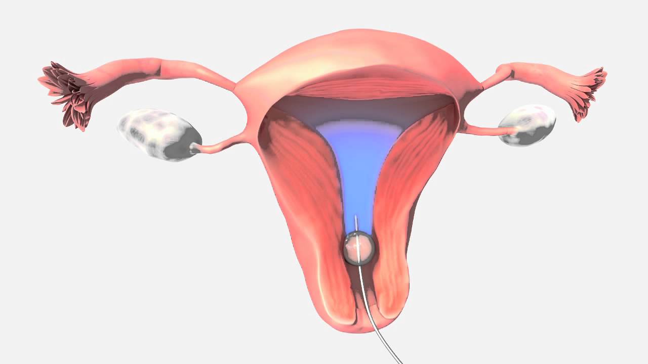 IUI là phương pháp bơm tinh trùng trực tiếp vào tử cung phụ nữ