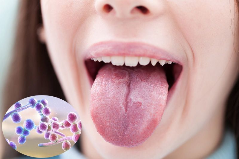 Bệnh nấm Candida miệng có lây không?