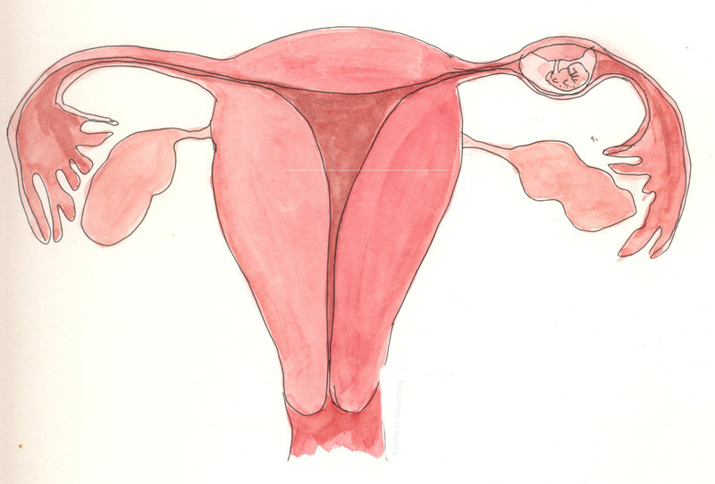 Có thai tháng đầu ra dịch màu nâu là dấu hiệu mang thai ngoài tử cung