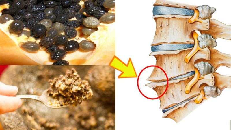 Dùng hạt đu đủ trị gai cột sống cổ Dùng hạt đu đủ trị gai cột sống cổ