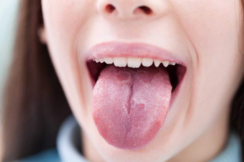 Nấm Candida mãn tính có thể gây nấm miệng liên tục trong thời gian dài
