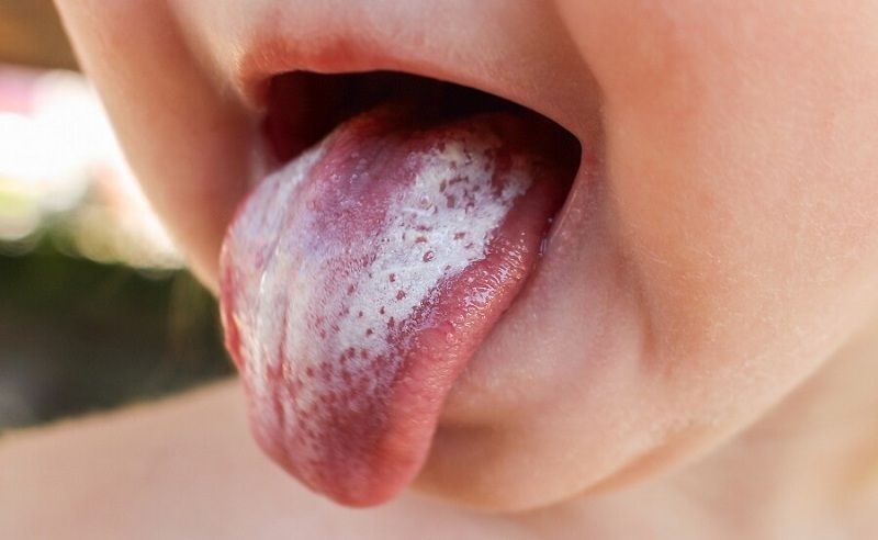 Nấm Candida miệng có lây không và lây qua đường nào là chủ yếu?