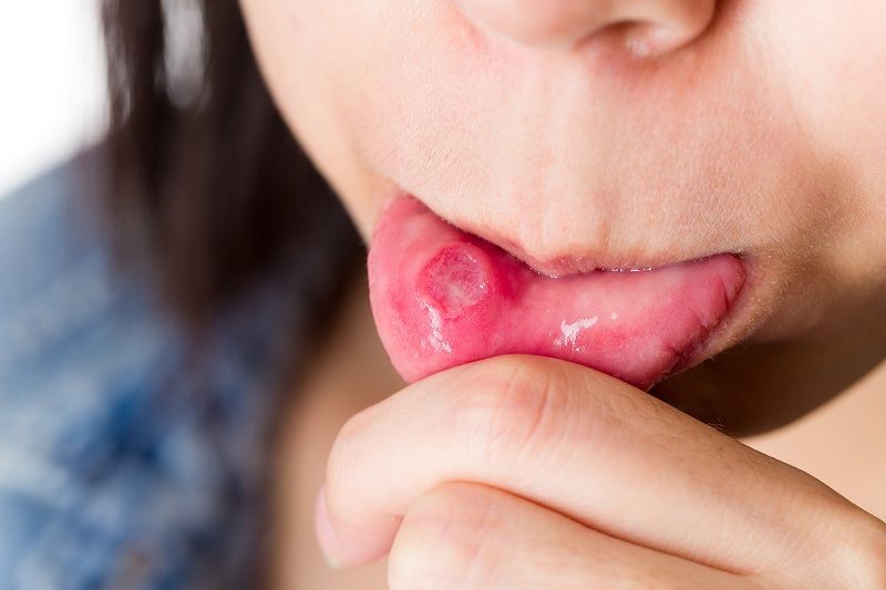 Nấm Candida ở miệng gây viêm loét và đau tấy