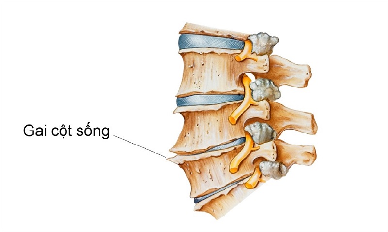 Tìm hiểu bệnh gai cột sông Tìm hiểu bệnh gai cột sống