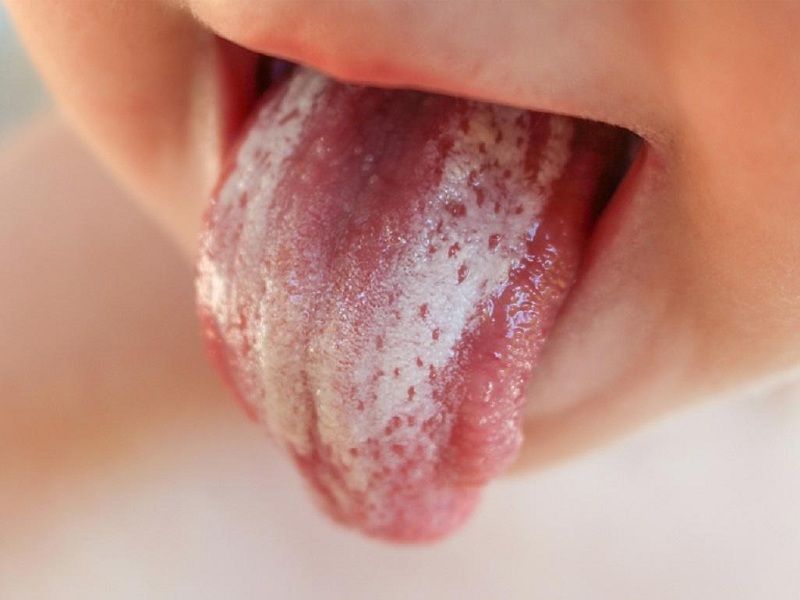 Tình trạng nấm Candida ở miệng của trẻ nhỏ