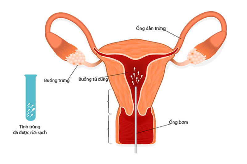 Tinh trùng được bơm trực tiếp vào buồng trứng của người phụ nữ