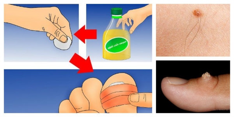 Bạn chỉ cần thấm giấm táo vào vùng da bị tổn thương là bệnh có thể thuyên giảm