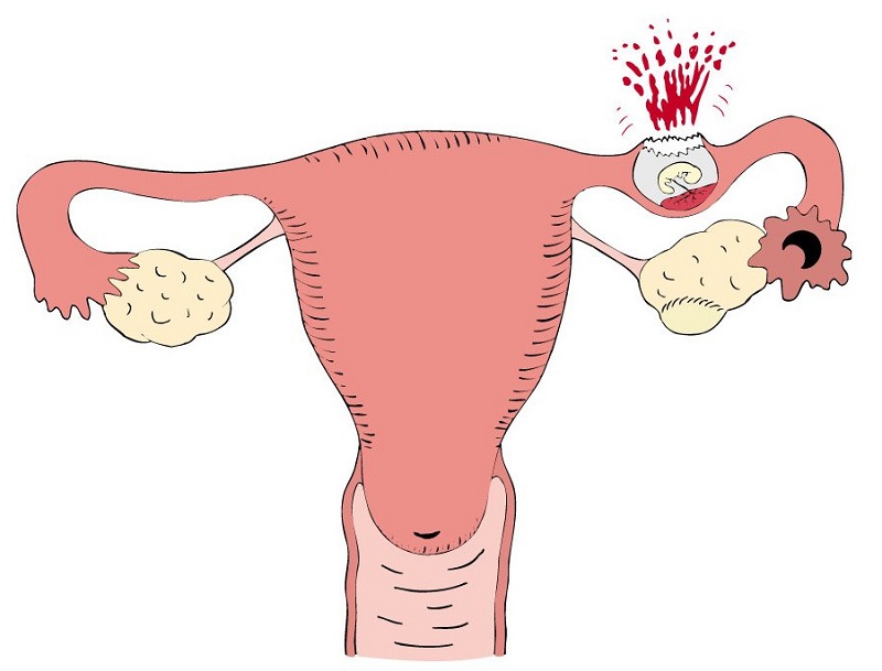 Viêm phần phụ làm tăng nguy cơ có thai ngoài tử cung của nữ giới