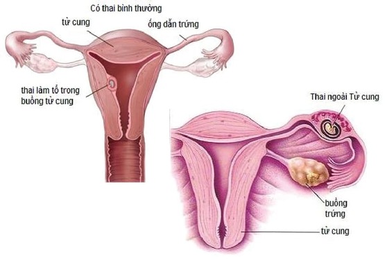 Có nhiều nguyên nhân dẫn tới tình trạng mang thai ngoài tử cung