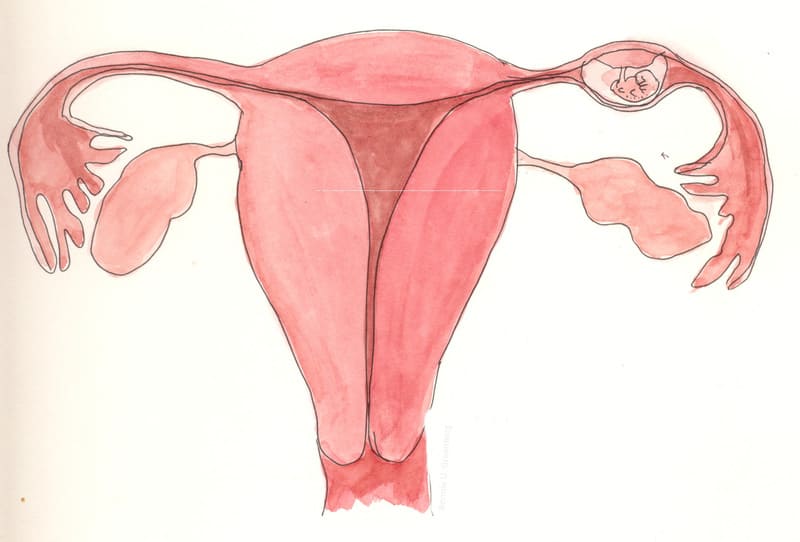 Làm IVF cũng có thể mang thai ngoLàm IVF cũng có thể mang thai ngoài tử cungài tử cung