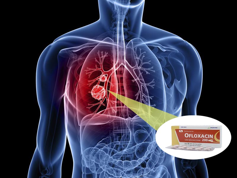 Liều dùng thuốc Ofloxacin cho người lớn bị viêm phổi