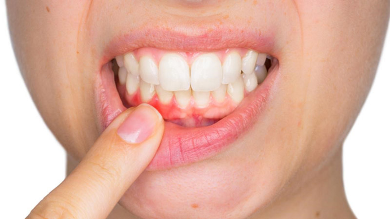 Safyral có thể gây ra tình trạng sưng tấy nướu răng ở người bệnh