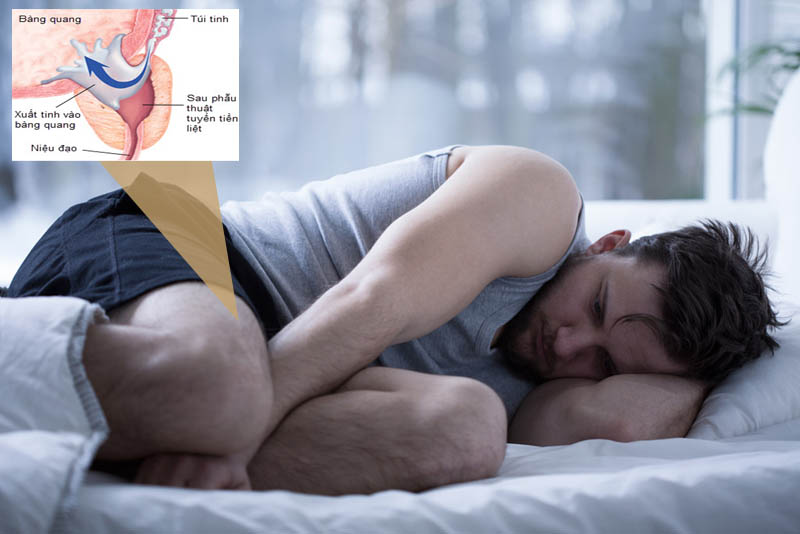 Bệnh xuất tinh ngược lên bàng quang là gì? Bệnh xuất tinh ngược lên bàng quang là gì?