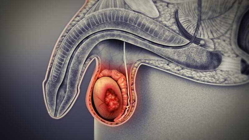 Nam giới bị viêm tinh hoàn có nguy cơ mắc phải tình trạng tinh trùng có máu khá cao Nam giới bị viêm tinh hoàn có nguy cơ mắc phải tình trạng tinh trùng có máu khá cao