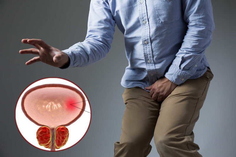 Bệnh viêm bàng quang do đâu mà có? Bệnh viêm bàng quang do đâu mà có?