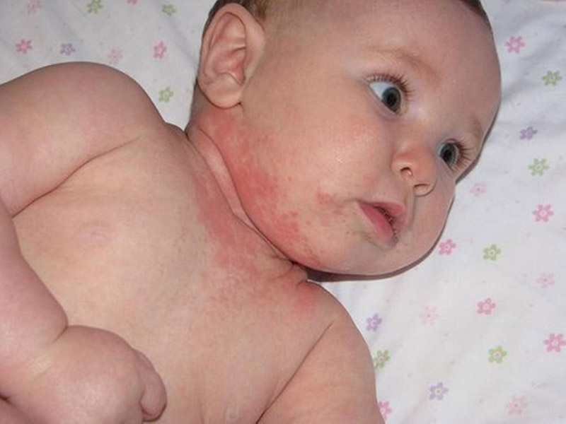 Chàm da cũng là bệnh lý khiến trẻ sơ sinh bị nổi mẩn ngứa khắp người