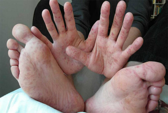 Mẩn ngứa ở chân, tay có thể là dấu hiêu một số bệnh da liễu