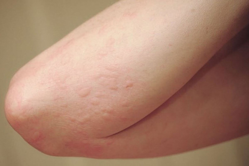 Mẩn ngứa nổi cục như muỗi đốt là dấu hiệu của bệnh lý gì?