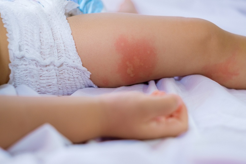 Một trong những nguyên nhân gây mẩn ngứa ở trẻ sơ sinh là do hăm da