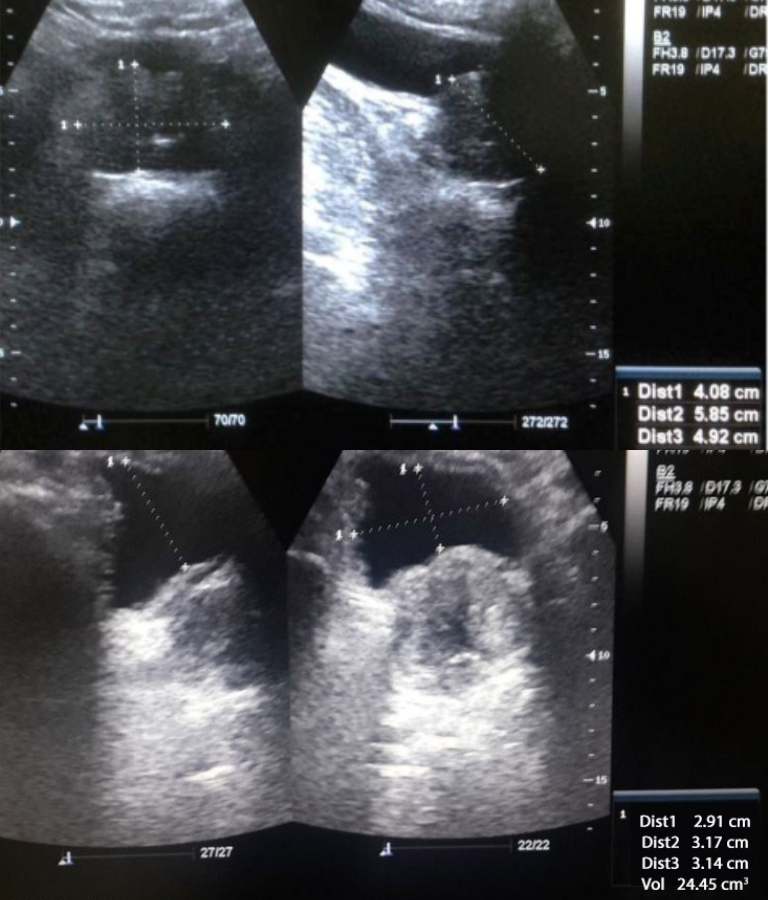 Hình ảnh siêu âm Tiền liệt tuyến của bác Đinh Văn Hòa trước và sau điều trị