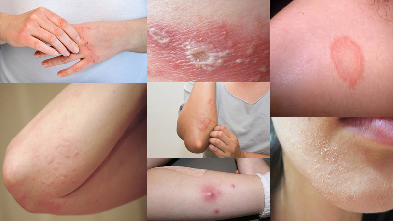 Một số hình ảnh viêm da, mức độ viêm nhiễm thường gặp