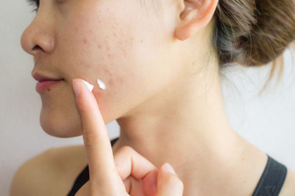 Kem thuốc trị mụn nội tiết