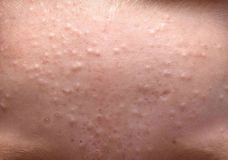Mụn ẩn không khó chữa tuy nhiên lại khá dai dẳng nếu không điều trị đúng cách