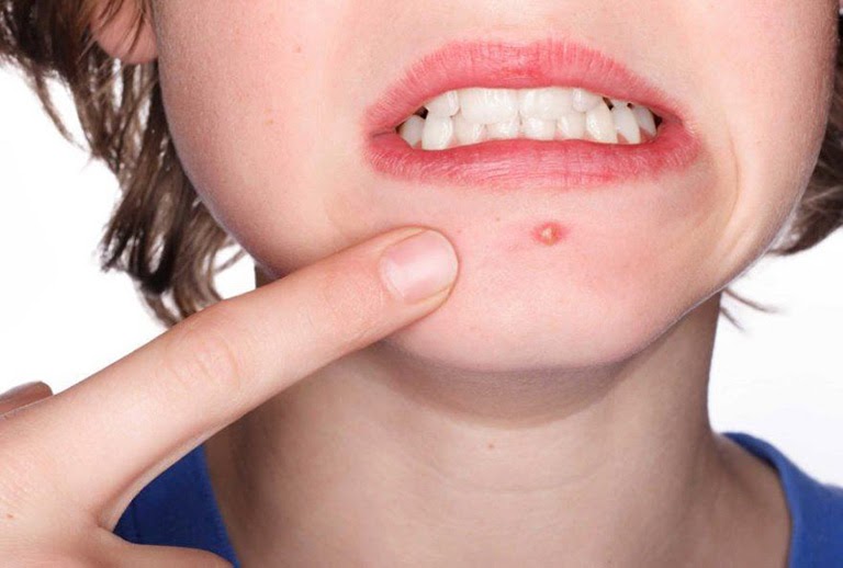 Mụn mủ cần điều trị đúng cách để có được hiệu quả tốt nhất