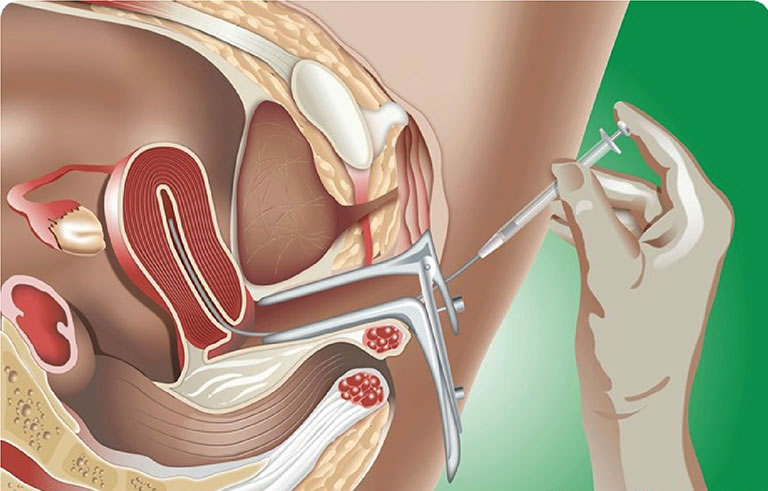 Kỹ thuật bơm tinh trùng vào buồng tử cung