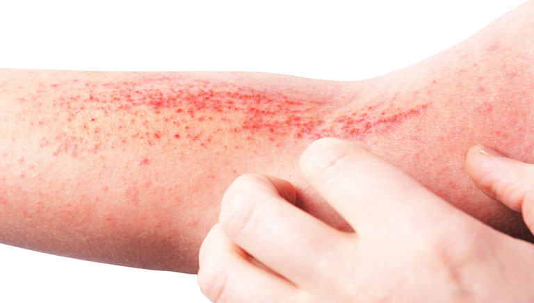 nổi mẩn đỏ trên da là bệnh gì