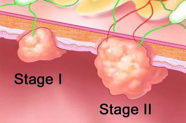 Dấu hiệu ung thư đại tràng giai đoạn 3