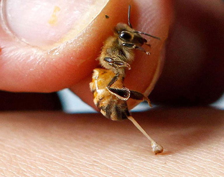 Chữa viêm khớp dạng thấp bằng nọc ong
