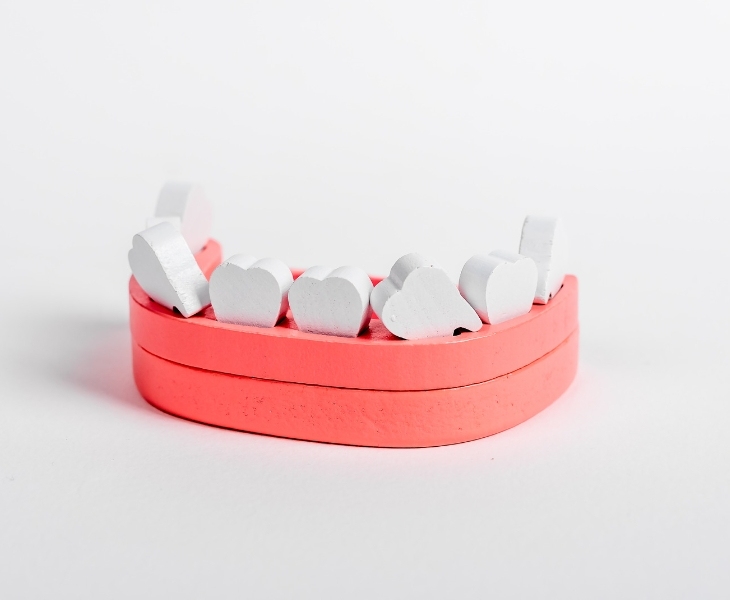 Răng lung lay là một trong những trường hợp không nên bọc răng sứ