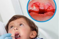 Trẻ bị viêm amidan sẽ tái lại thường xuyên ảnh hưởng đến sức khỏe